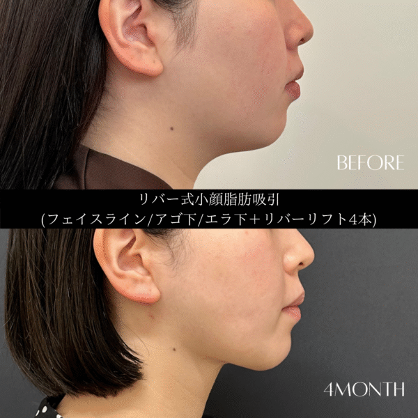 リバー式小顔脂肪吸引　145