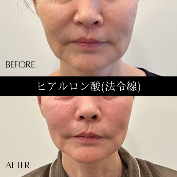 ヒアルロン酸 9