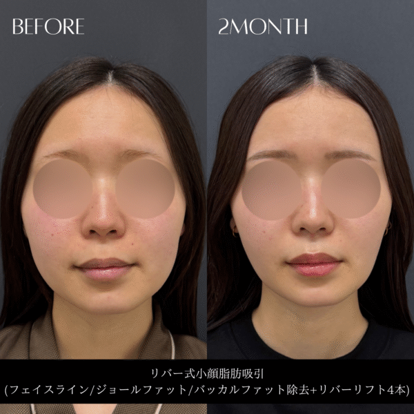 リバー式小顔脂肪吸引　146