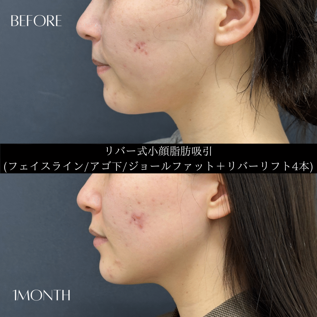 リバー式小顔脂肪吸引　144