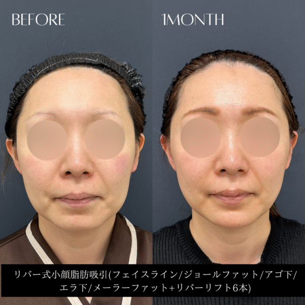 リバー式小顔脂肪吸引　152