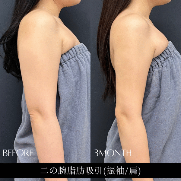 二の腕脂肪吸引　15