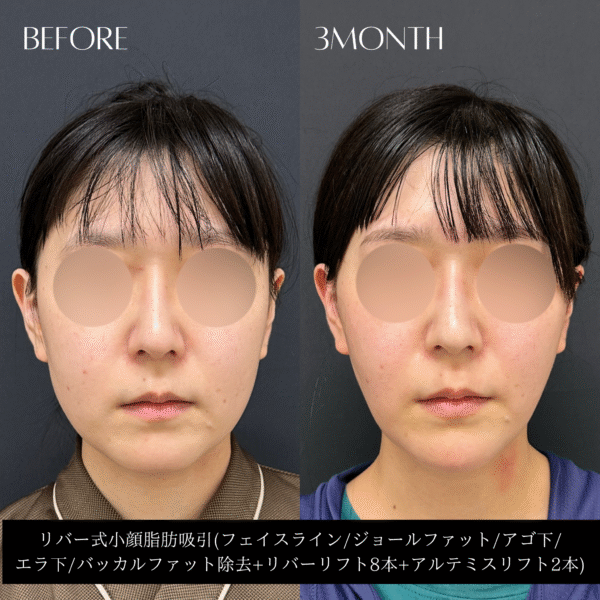 リバー式小顔脂肪吸引　155