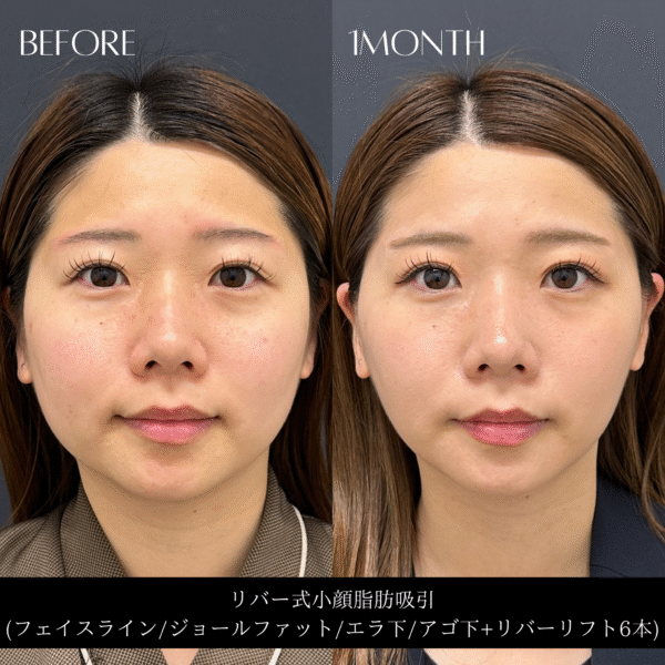 リバー式小顔脂肪吸引　154