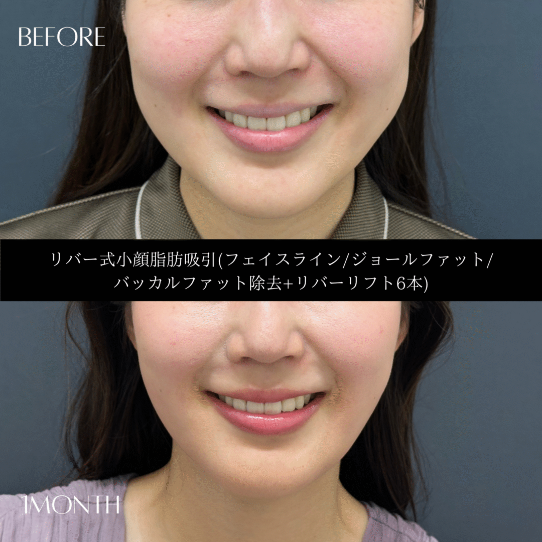 リバー式小顔脂肪吸引　156
