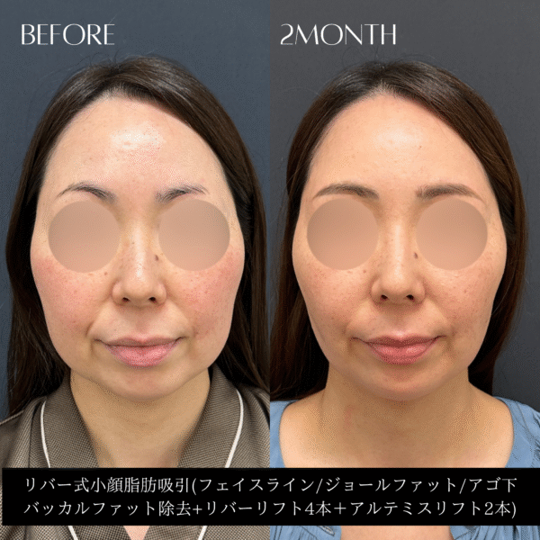 リバー式小顔脂肪吸引　153