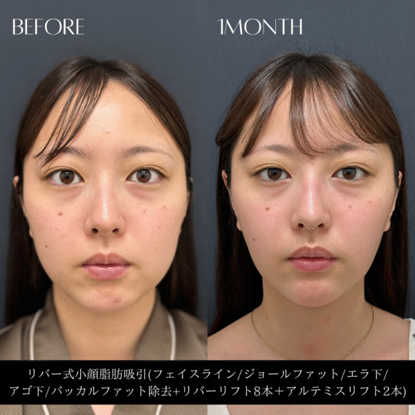 リバー式小顔脂肪吸引　157