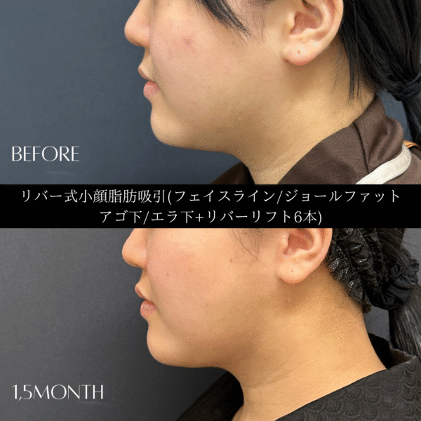 リバー式小顔脂肪吸引　159