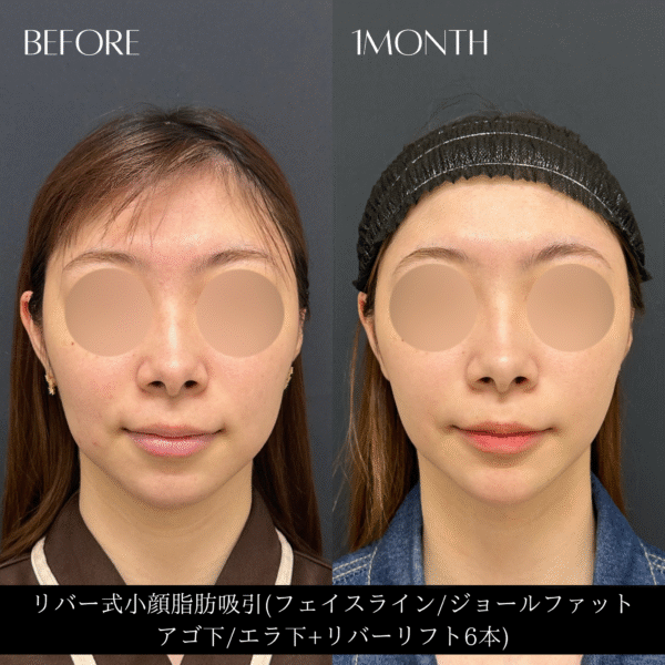 リバー式小顔脂肪吸引　160