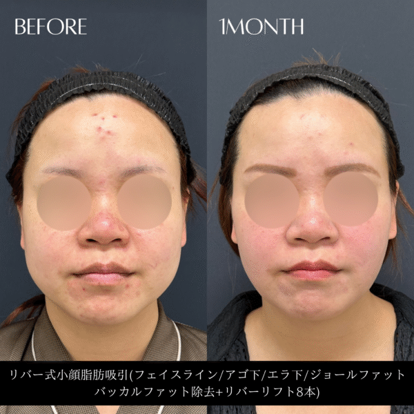 リバー式小顔脂肪吸引　158