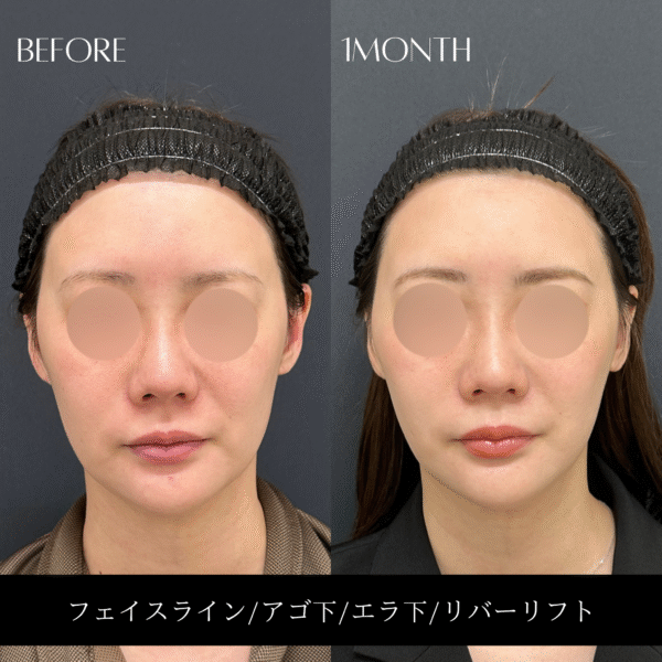 リバー式小顔脂肪吸引 161
