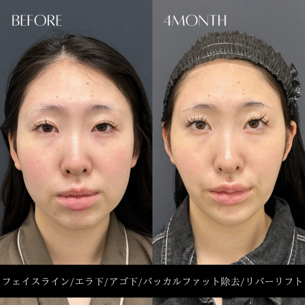 リバー式小顔脂肪吸引 165