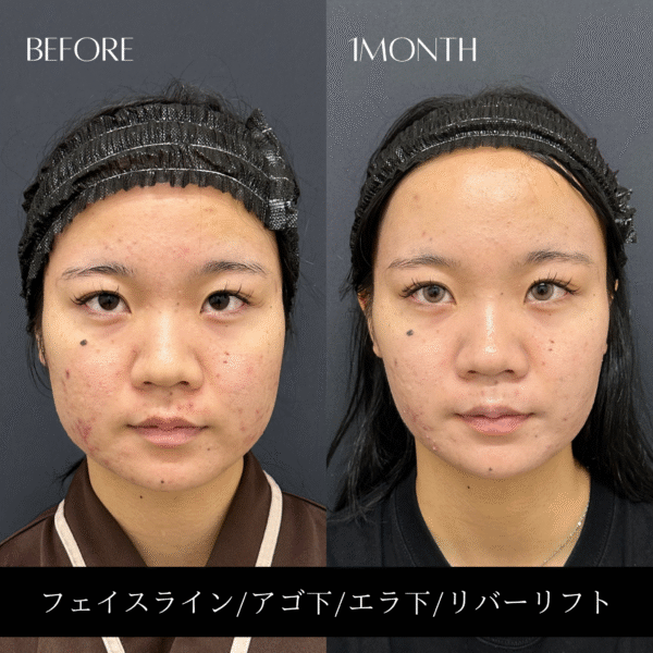 リバー式小顔脂肪吸引 163