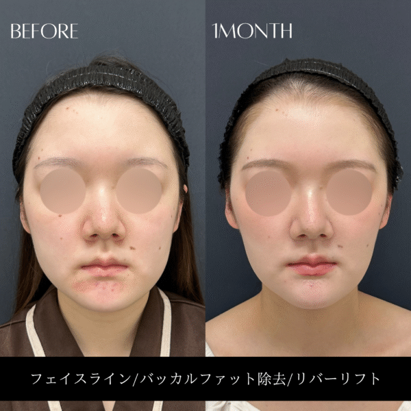 リバー式小顔脂肪吸引 162