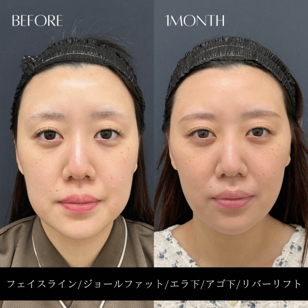 リバー式小顔脂肪吸引 164