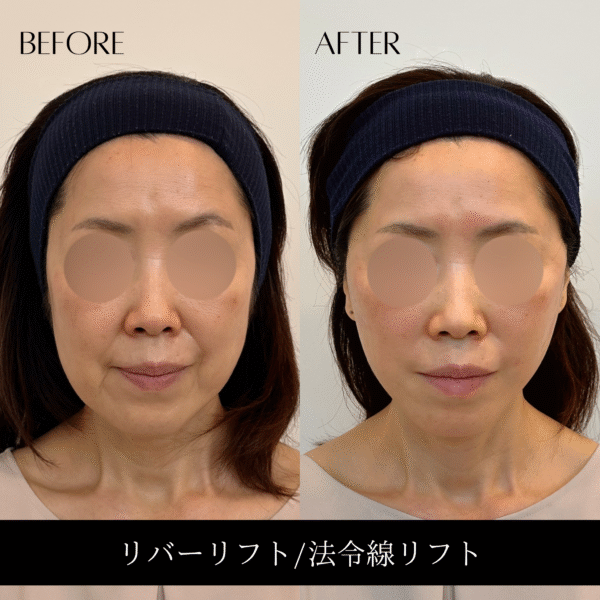 リバーリフト 34