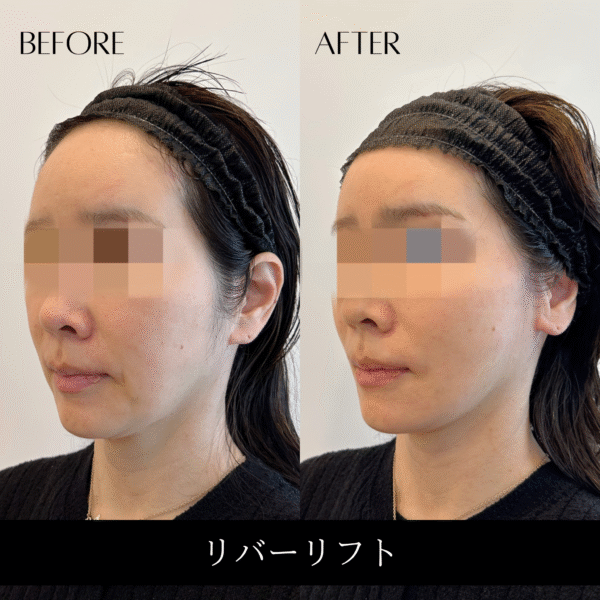 リバーリフト 33