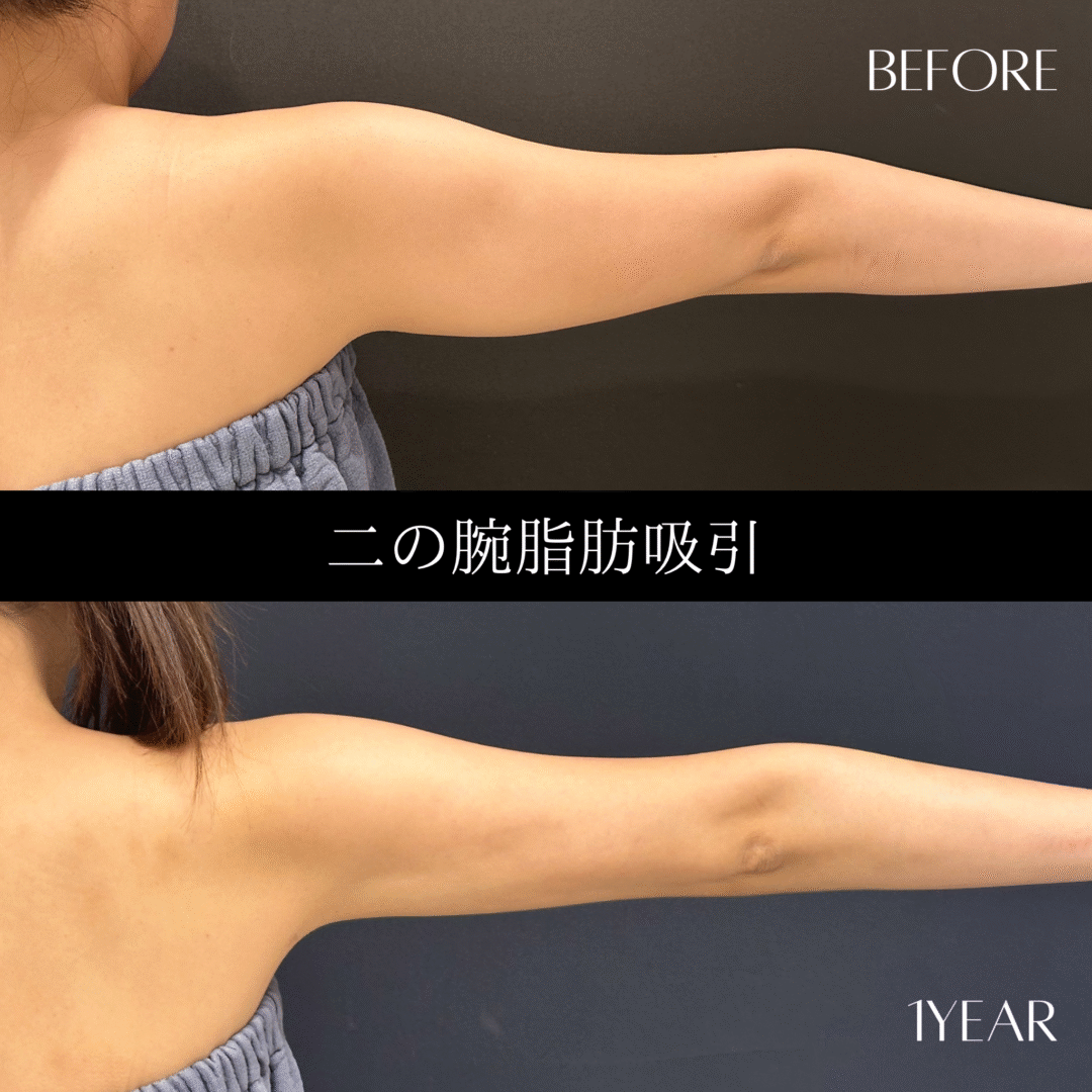 二の腕脂肪吸引 16