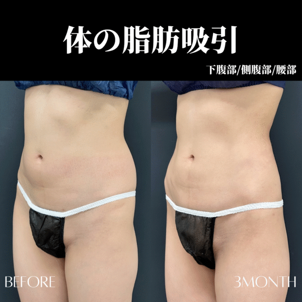 お腹・腰の脂肪吸引 1