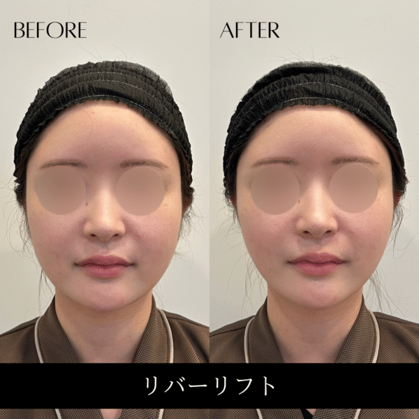 リバーリフト 32