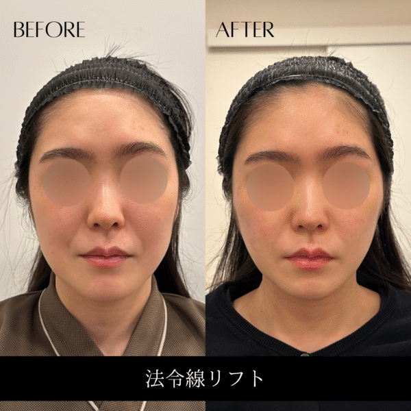 ほうれい線リフト 1