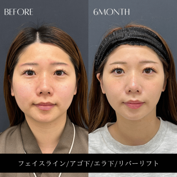 リバー式小顔脂肪吸引　166