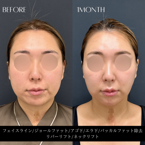 リバー式小顔脂肪吸引　169