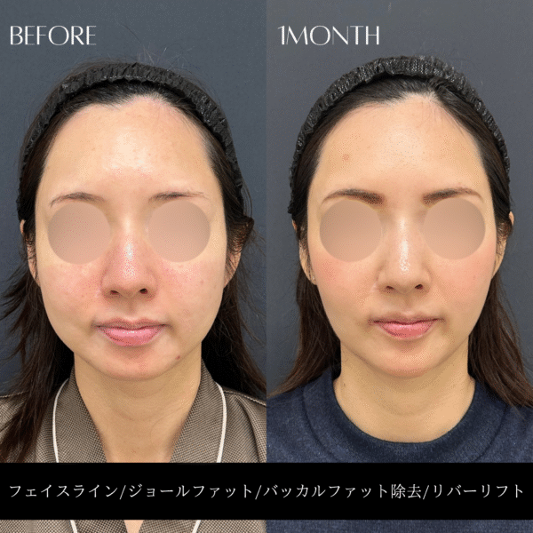 リバー式小顔脂肪吸引　168