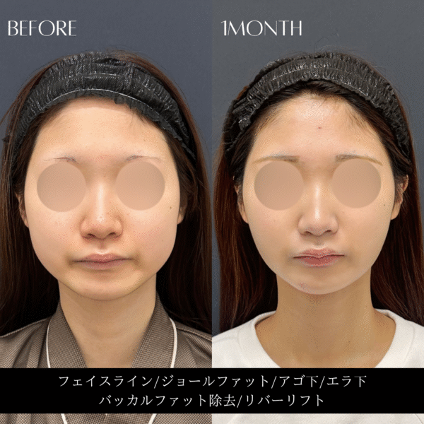 リバー式小顔脂肪吸引　167