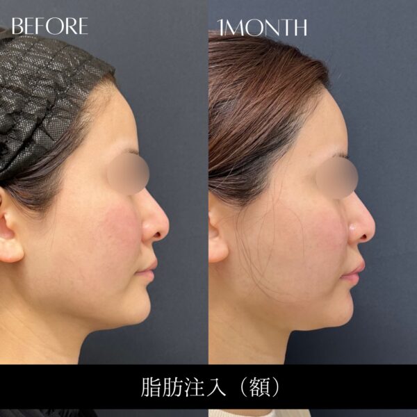 脂肪注入　3
