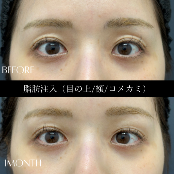 脂肪注入　１