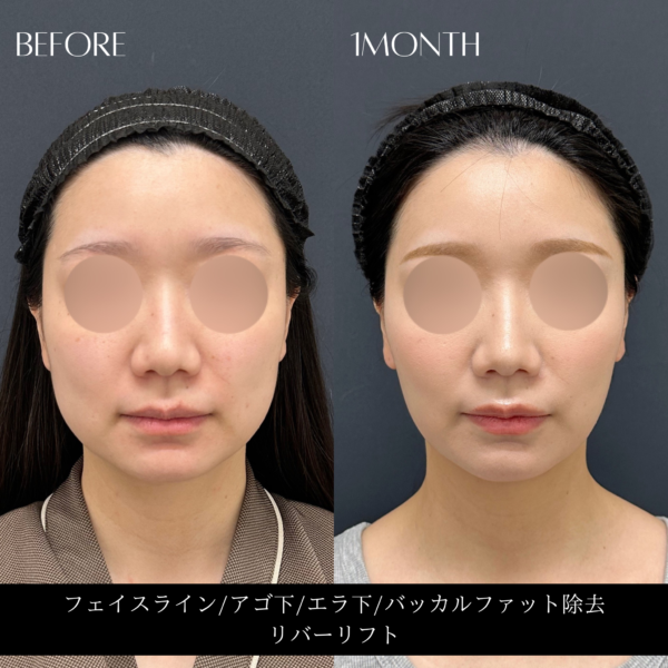 リバー式小顔脂肪吸引　170