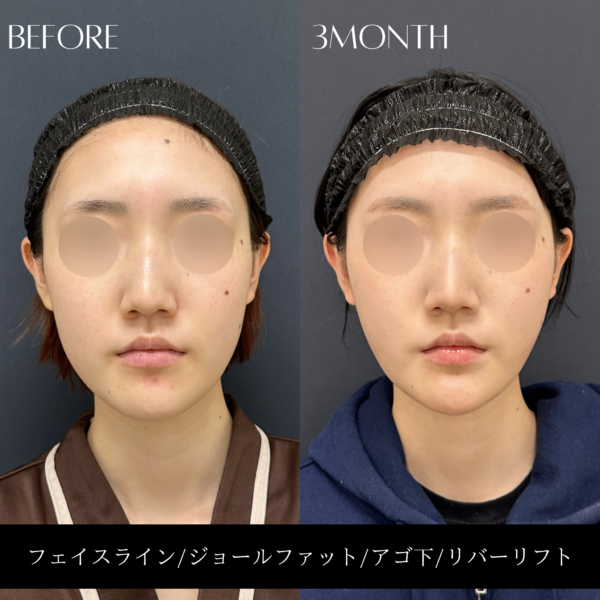 リバー式小顔脂肪吸引　171