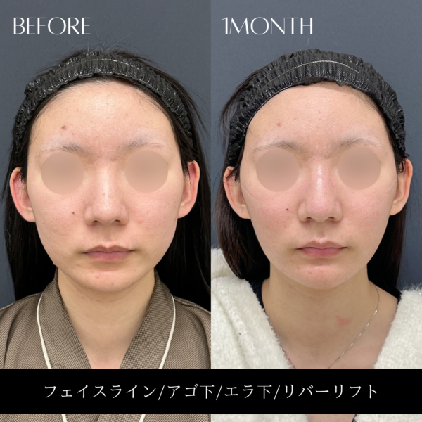 リバー式小顔脂肪吸引　172