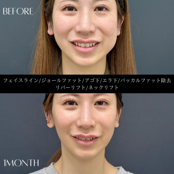 リバー式小顔脂肪吸引　173