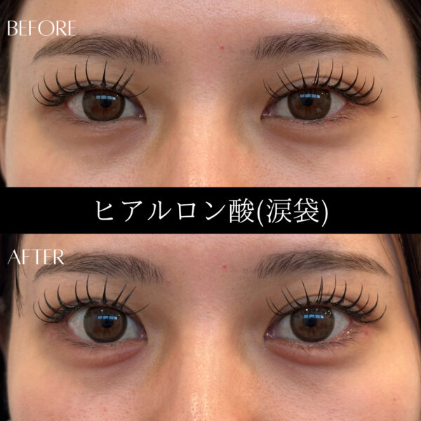 ヒアルロン酸 10