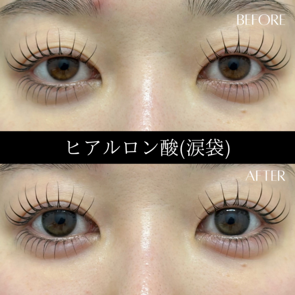 ヒアルロン酸 13