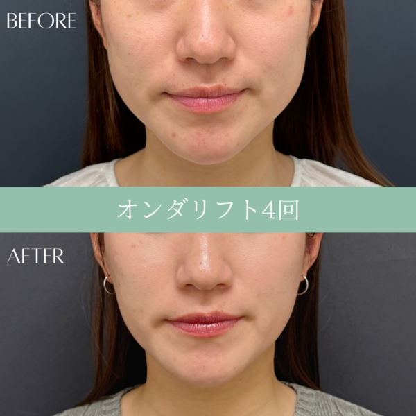 オンダリフト　2