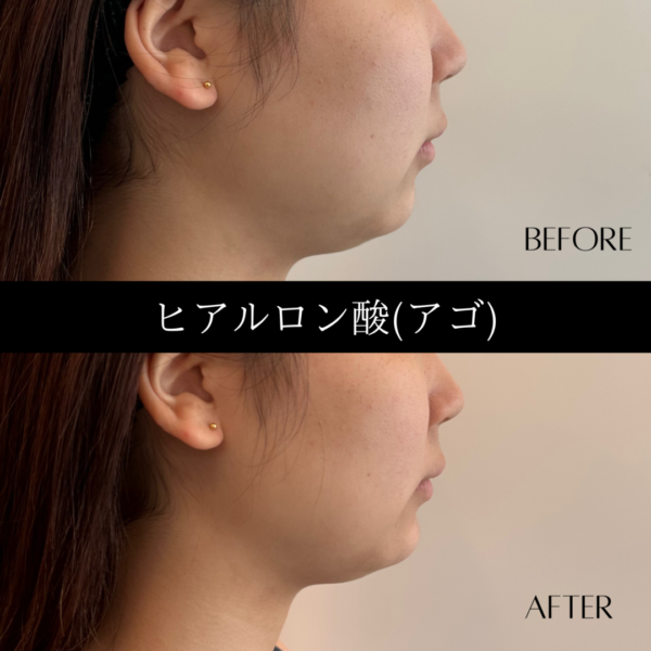 ヒアルロン酸 12