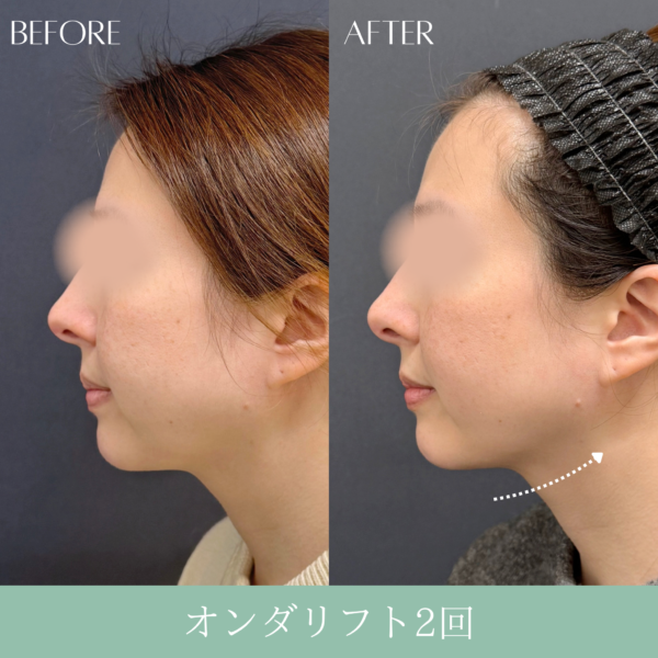 オンダリフト　3