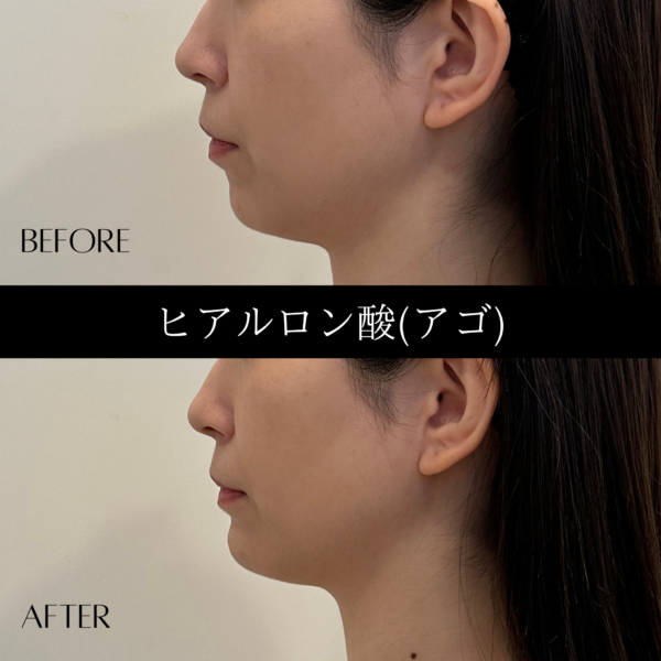 ヒアルロン酸 11