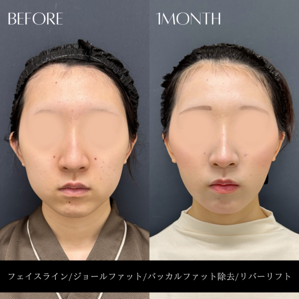 リバー式小顔脂肪吸引　174