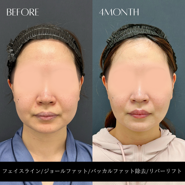 リバー式小顔脂肪吸引　178