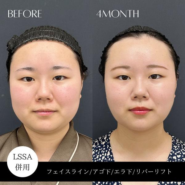 リバー式小顔脂肪吸引　175
