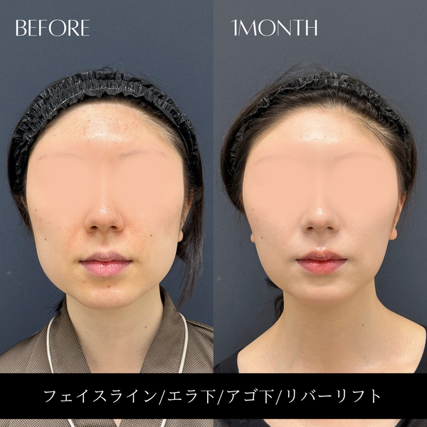 リバー式小顔脂肪吸引　177