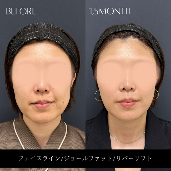 リバー式小顔脂肪吸引　176
